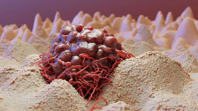 سرطان پوست چیست؟